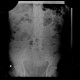 Gastroenteritis, acute, diarrhea: X-ray - Plain radiograph