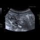 Gastroenteritis, acute, diarrhea: US - Ultrasound