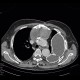 Pseudoaneurysm of aorta, replacement of ascending aorta, haemothorax: CT - Computed tomography