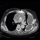 Pseudoaneurysm of aorta, replacement of ascending aorta, haemothorax: CT - Computed tomography