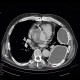 Pseudoaneurysm of aorta, replacement of ascending aorta, haemothorax: CT - Computed tomography