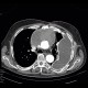 Pseudoaneurysm of aorta, replacement of ascending aorta, haemothorax: CT - Computed tomography