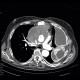 Pseudoaneurysm of aorta, replacement of ascending aorta, haemothorax: CT - Computed tomography