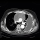 Pseudoaneurysm of aorta, replacement of ascending aorta, haemothorax: CT - Computed tomography