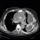 Pseudoaneurysm of aorta, replacement of ascending aorta, haemothorax: CT - Computed tomography