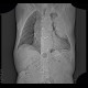 Pseudoaneurysm of aorta, replacement of ascending aorta, haemothorax: CT - Computed tomography