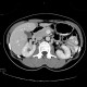 Pseudolesion in liver, falciform ligament: CT - Computed tomography