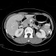 Pseudolesion in liver, falciform ligament: CT - Computed tomography