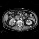 Pyelonephritis, kidney: CT - Computed tomography