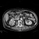 Pyelonephritis, kidney: CT - Computed tomography