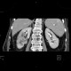 Pyelonephritis, kidney: CT - Computed tomography