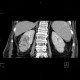 Pyelonephritis, kidney: CT - Computed tomography