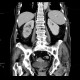 Pyelonephritis, kidney, follow-up: CT - Computed tomography