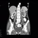 Pyelonephritis: CT - Computed tomography