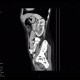 Pyelonephritis: CT - Computed tomography