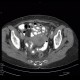 Pyometra, reactive changes of small bowel: CT - Computed tomography
