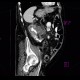 Pyonephros, renal stones, casting, staghorn calculus, nephrolithiasis: CT - Computed tomography