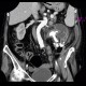 Pyonephros, renal stones, casting, staghorn calculus, nephrolithiasis: CT - Computed tomography