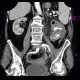 Pyonephros, renal stones, casting, staghorn calculus, nephrolithiasis: CT - Computed tomography