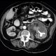 Pyonephros, renal stones, casting, staghorn calculus, nephrolithiasis: CT - Computed tomography