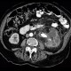 Pyonephros, renal stones, casting, staghorn calculus, nephrolithiasis: CT - Computed tomography