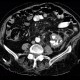 Pyonephros, renal stones, casting, staghorn calculus, nephrolithiasis: CT - Computed tomography