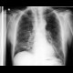 Pulmonary fibrosis, rheumatoid arthritis: X-ray - Plain radiograph