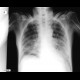 Pulmonary fibrosis, rheumatoid arthritis, alveolitis, exacerbation: X-ray - Plain radiograph