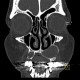 Periapical cyst, radicular cyst: CT - Computed tomography