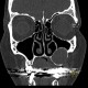 Periapical cyst, radicular cyst: CT - Computed tomography