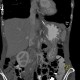 Gastric folds, prominent: CT - Computed tomography