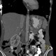 Gastric folds, prominent: CT - Computed tomography