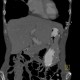 Gastric folds, prominent: CT - Computed tomography