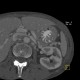 Gastric folds, prominent: CT - Computed tomography