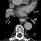 Reflux esophagitis on CT: CT - Computed tomography