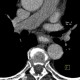 Reflux esophagitis on CT: CT - Computed tomography