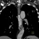 Reflux esophagitis on CT: CT - Computed tomography