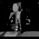 Reflux esophagitis on CT: CT - Computed tomography