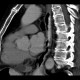 Reflux esophagitis on CT: CT - Computed tomography