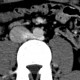 Retroaortic renal vein, duplication of renal vein: CT - Computed tomography
