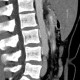 Retroaortic renal vein, duplication of renal vein: CT - Computed tomography