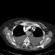 Retrosternal struma: CT - Computed tomography