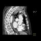 Retrosternal struma: CT - Computed tomography