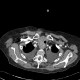 Retrosternal struma: CT - Computed tomography