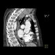 Retrosternal struma: CT - Computed tomography