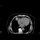 Radiofrequency ablation, RFA, mediastinal tumour: CT - Computed tomography