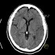 Brain ischemia, MCA, day 1: CT - Computed tomography