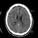 Brain ischemia, MCA, day 1: CT - Computed tomography