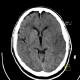 Brain ischemia, MCA, day 2: CT - Computed tomography