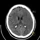 Brain ischemia, MCA, day 2: CT - Computed tomography